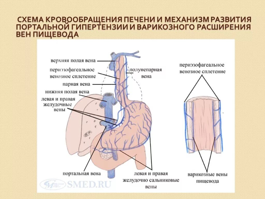 Лечение вен пищевода. Портальная гипертензия портокавальные анастомозы. Портальная гипертензия воротной вены. Схема развития портальной гипертензии. Расширение пищеводных вен при портальной гипертензии.