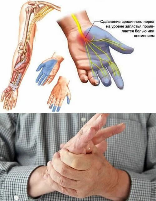 Болит сустав у основания большого пальца руки. Запястный туннельный синдром. Карпальный туннельный синдром стопы. Защемление туннельного нерва. Туннельная нейропатия срединного нерва.