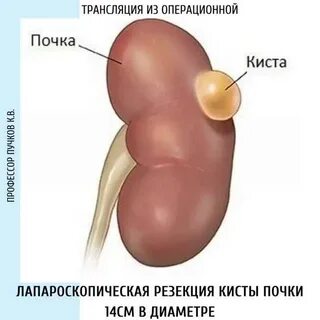 Народное лечение кисты почек у женщин