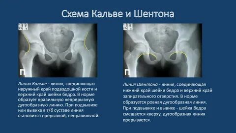 Диагностика вывиха бедра