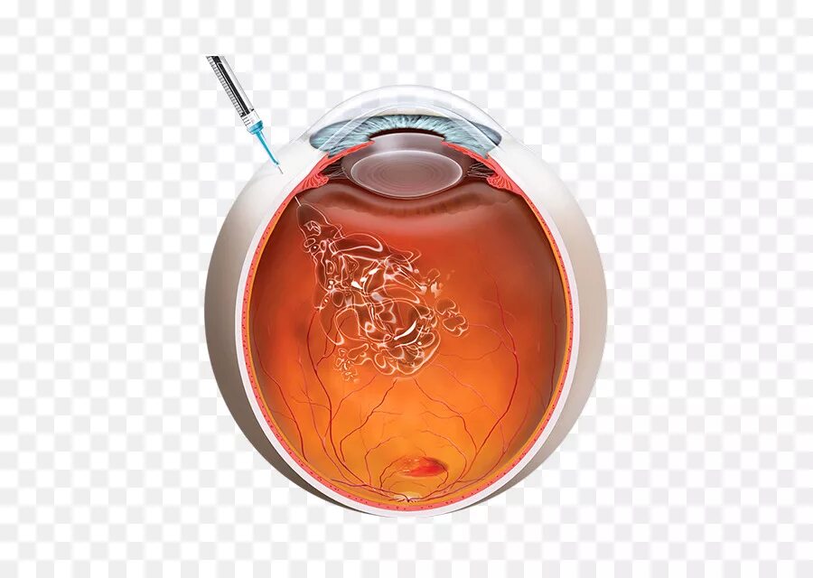 интравитреальный имплантат. введение интравитреальное введение. имплант озурдекс. интравитреальное введение ингибиторов ангиогенеза. интравитреальное введение луцентиса.