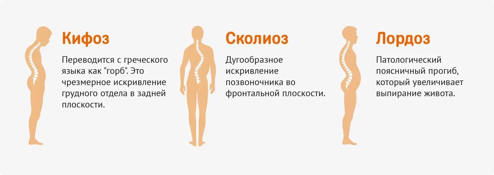 Сколиоз какой врач лечит позвоночника у взрослых. Сколиоз позвоночника. сильное искривление позвоночника. искривление позвоночника в грудном отделе.