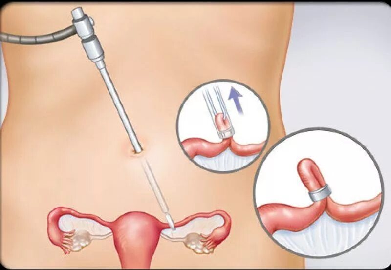 Как перевязывают трубы у женщин. Хирургическая стерилизация маточных труб. Лапароскопическая перевязка труб. Лапароскопия маточных труб. Лапароскопическая хирургическая стерилизация.