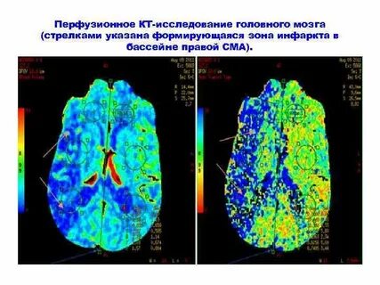 Ишемический инсульт в бассейне средней мозговой артерии