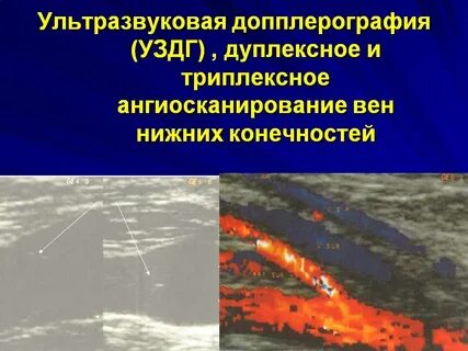 Дуплексное вен нижних конечностей