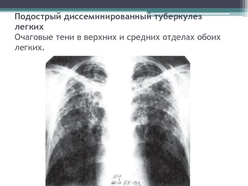Гематогенно диссеминированный туберкулез рентген. Острый диссеминированный туберкулез рентген. Крупноочаговый диссеминированный туберкулез рентген. Острый диссеминированный туберкулез легких рентген. Тени в верхней доле легкого