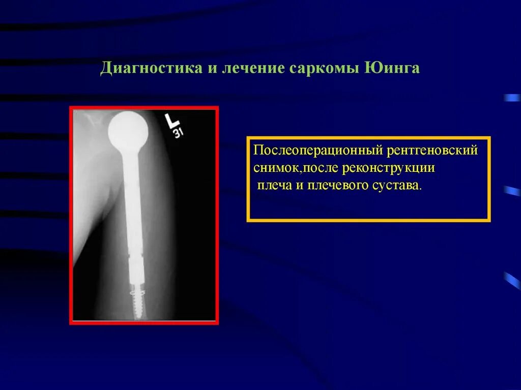 Степени саркомы. Саркома Юинга плечевой кости рентген. Саркома Юинга опухоль костей.