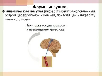 Чем отличается инфаркт мозга от инсульта