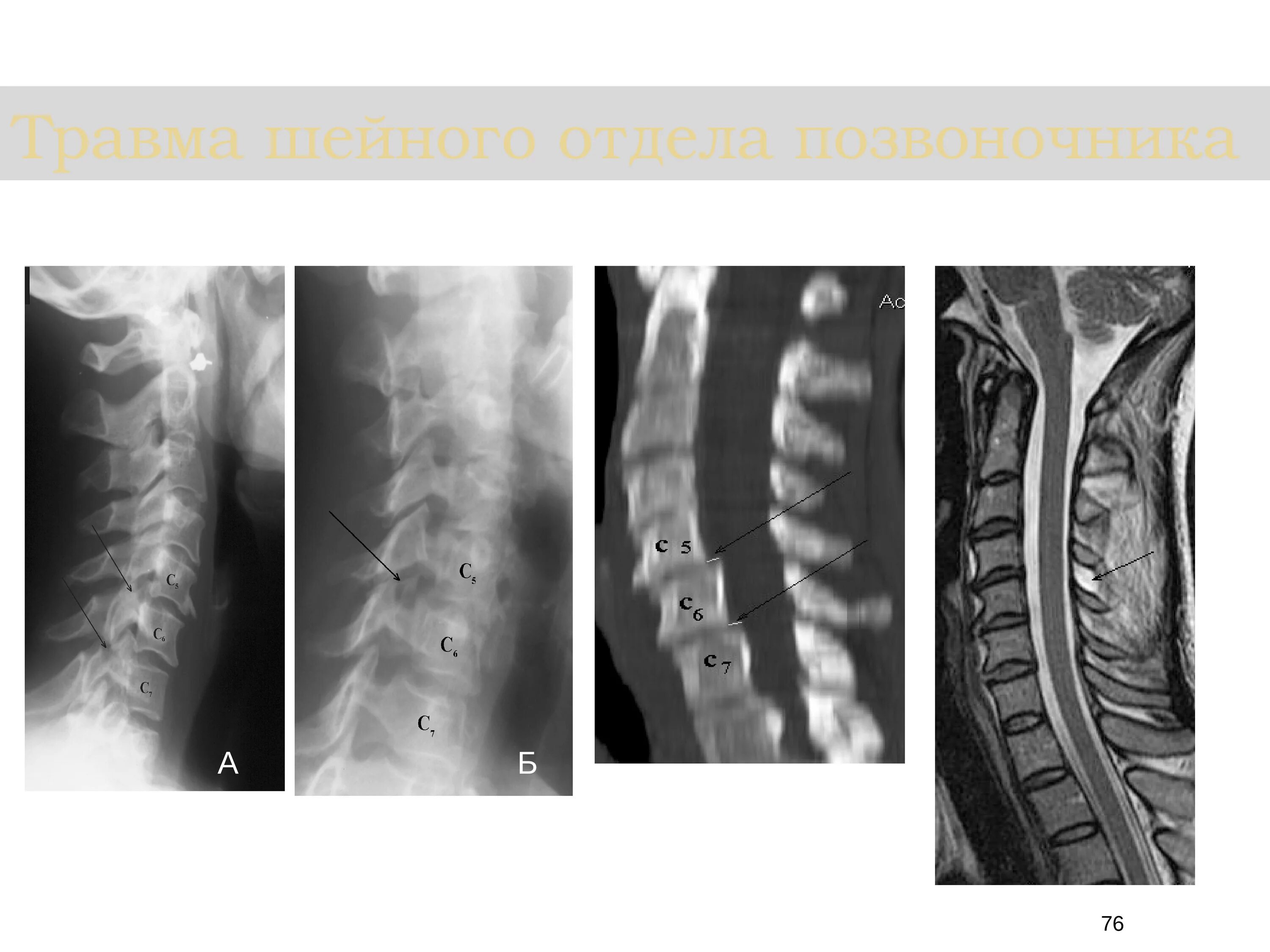 Шейный отдел позвоночника диагнозы. Спинальная травма шейного отдела позвоночника. Родовая травма шейного отдела позвоночника рентген. Хлыстовая травма шейного отдела позвоночника рентген. Нестабильность шейного отдела позвоночника новорожденного.