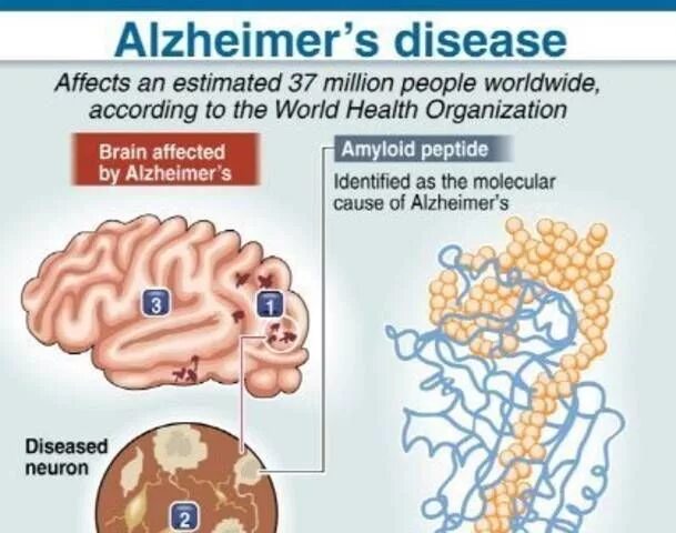 Alzheimer's disease. Alzheimer's disease Symptoms. Болезнь Альцгеймера деменция.