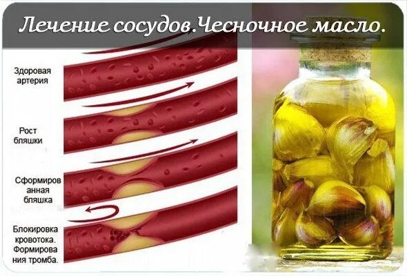 Чеснок при атеросклерозе. Чесночное масло для сосудов. рецепт для сосудов. чеснок для сосудов. продукты для сосудов чеснок.
