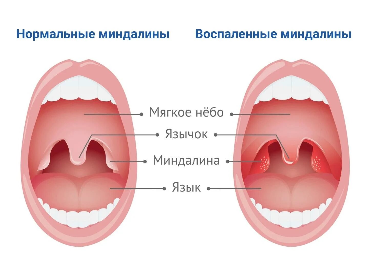 Полость страдать. Строение аденоиды небные миндалины. Поверхность небных миндалин. Ангина небных миндалин. Аденоиды гланды и миндалины у детей.