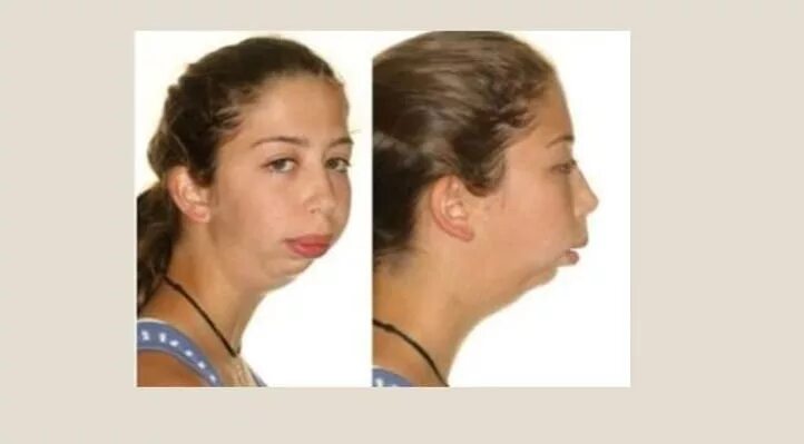 Missing Teeth Philadelphia PA Dental Implants Dental Bridge