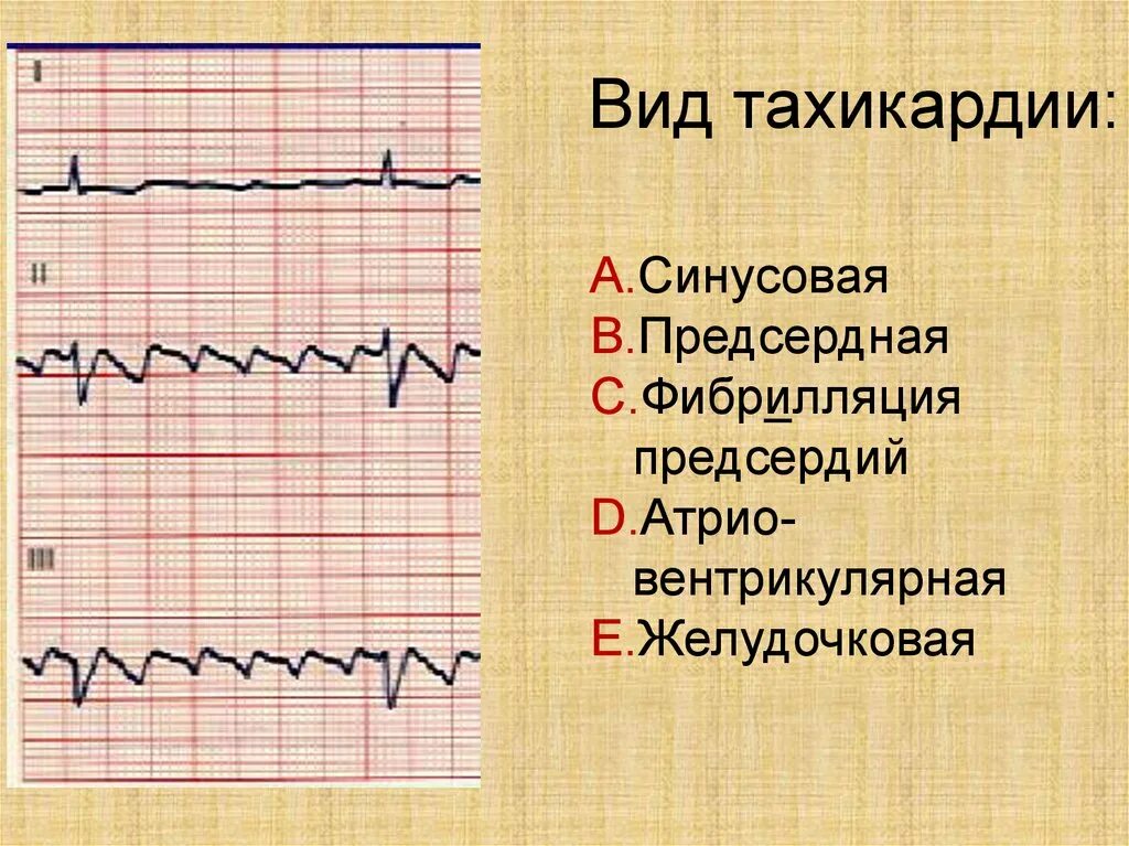 Тахикардия. Тахикардия на экг. Синусовая и предсердная тахикардия. Типы тахикардии. Синусовая и предсердная тахикардия.