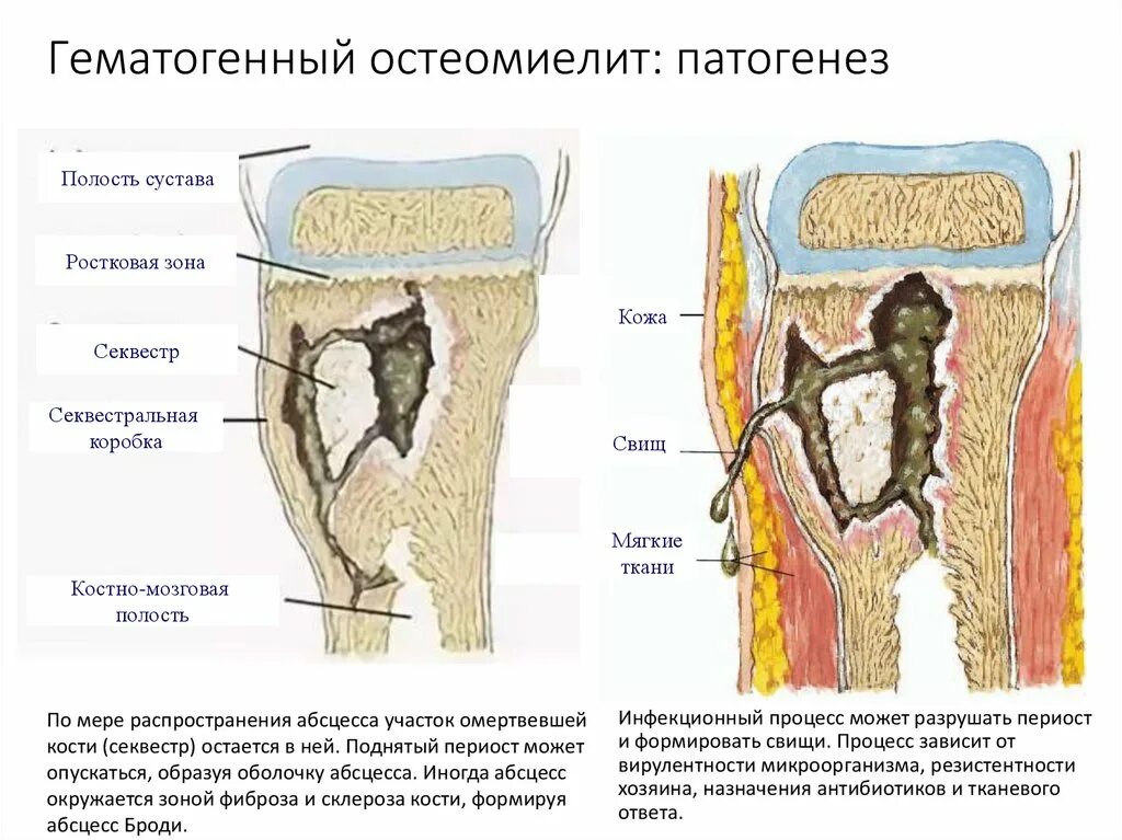 Патогенез острого гематогенного остеомиелита. Гематогенный остеомиелит у детей патогенез. Патогенез острого гематогенного остеомиелита. Стадии развития острого гематогенного остеомиелита. Гематогенный остеомиелит у детей классификация.