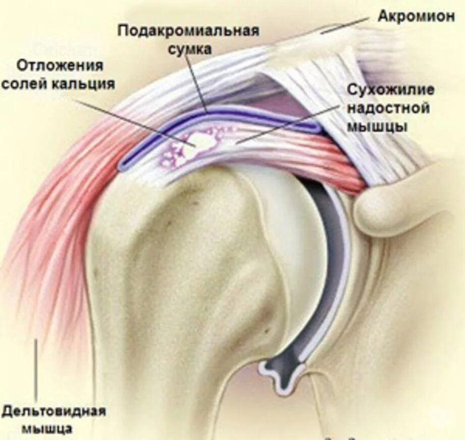 Как лечат разрыв сухожилия плечевого. Тендопатия сухожилия надостной мышцы. травма сухожилия надостной мышцы. тендинит сухожилия плечевого сустава. тендинопатия сухожилия подлопаточной мышцы.