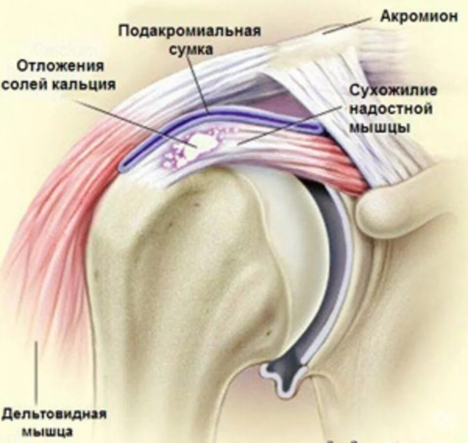 Тендопатия сухожилия надостной мышцы. Травма сухожилия надостной мышцы. Тендинит ротаторной манжеты плечевого сустава. Поражения сухожилия надостной мышцы. Эффективное лечение плечевого сустава