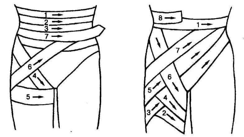 Как перевязать карту. Колосовидная повязка на тазобедренный сустав. Наложение колосовидной повязки на тазобедренный сустав. Колосовидная повязка алгоритм. Колосовидная повязка на бедренный сустав.