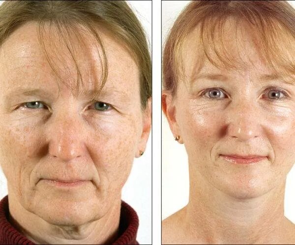 подтяжки лица пиявками