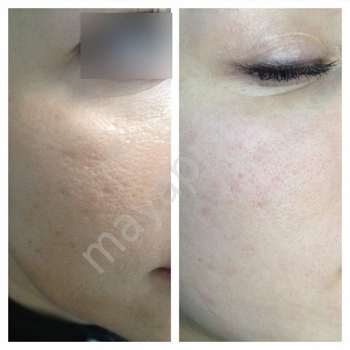 После лазерной шлифовки. Лазерная шлифовка ростов. Лазерная шлифовка ростов. Лазерная шлифовка ростов. Лазерной шлифовки шрамов co2.