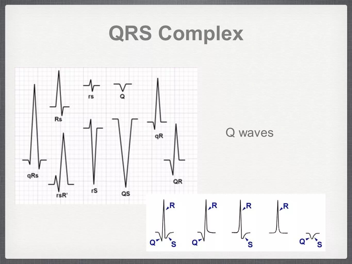 Комплекс QRS типа RSR. Комплекс QRS на ЭКГ. Комплекс QRS на электрокардиограмме отражает. ECG normal QRS Complex.