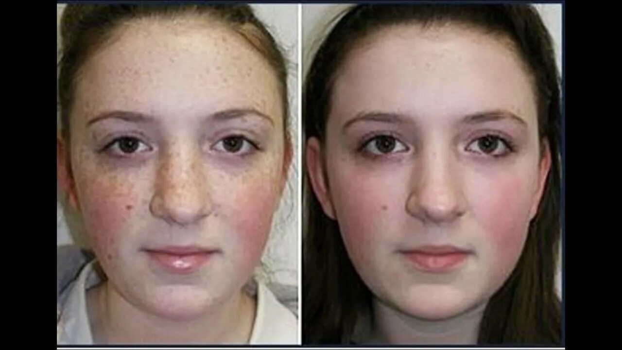 Маски для лица до и после. Отбеливание кожи. Осветление кожи до и после. Отбелил кожу до и после.