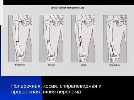Линия перелома прослеживается