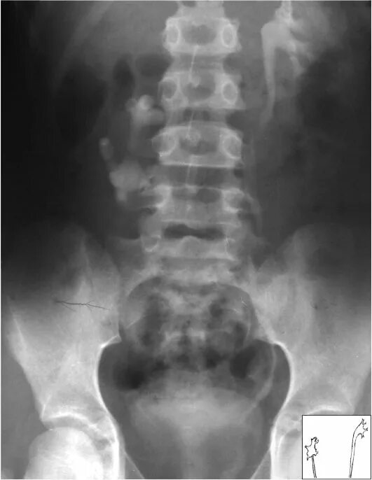 ротация почки