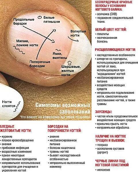 Диагностика по ногтям. Выявление болезни по ногтям. Определить болезнь по ногтям. Как отличить болезнь