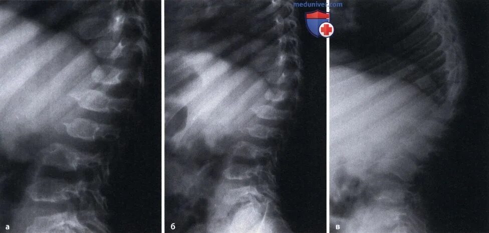 Эпифизарная дисплазия лучезапястного. Спондилоэпифизарной дисплазией. Спондило эпифизарную дисплазию. Метаэпифизарная дисплазия. Спондилоэпифизарную дисплазию.
