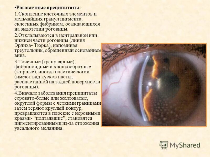 преципитаты на роговице