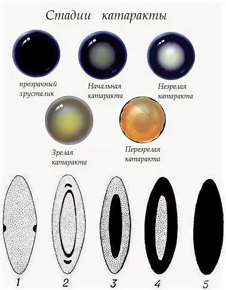 Как выглядит хрусталик глаза при катаракте A Brief Introduction to Intraocular Lenses Bücher