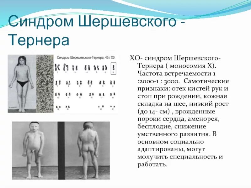Синдром шерешевского тернера кратко. Синдром шерешевского тернера частота встречаемости. синдром клайнфельтера и шерешевского тернера. синдром тернера-шершевского (хо). шерешевского тернера синдром кариотип причины.