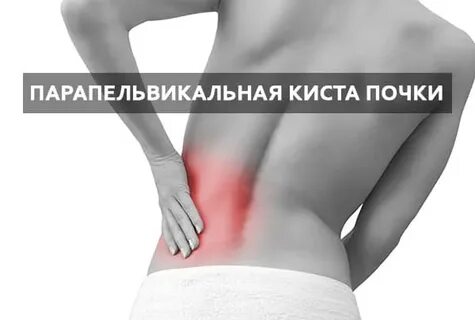 Боли при кисте