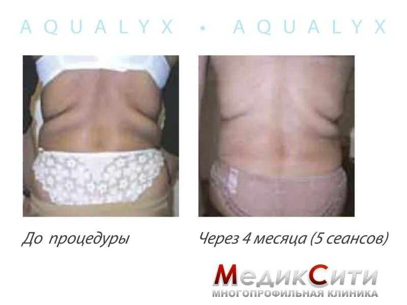 Через сколько эффект от липолитиков