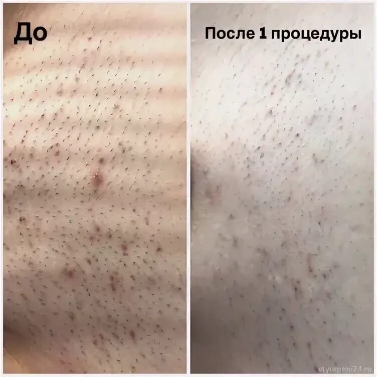 Курс лазерной эпиляции сколько процедур. Выпадают волосы после лазерной эпиляции. лазерная эпиляция уход после процедуры. сколько растут волосы после лазерной эпиляции. какой интервал между сеансами лазерной эпиляции.