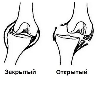 Закрытый вывих