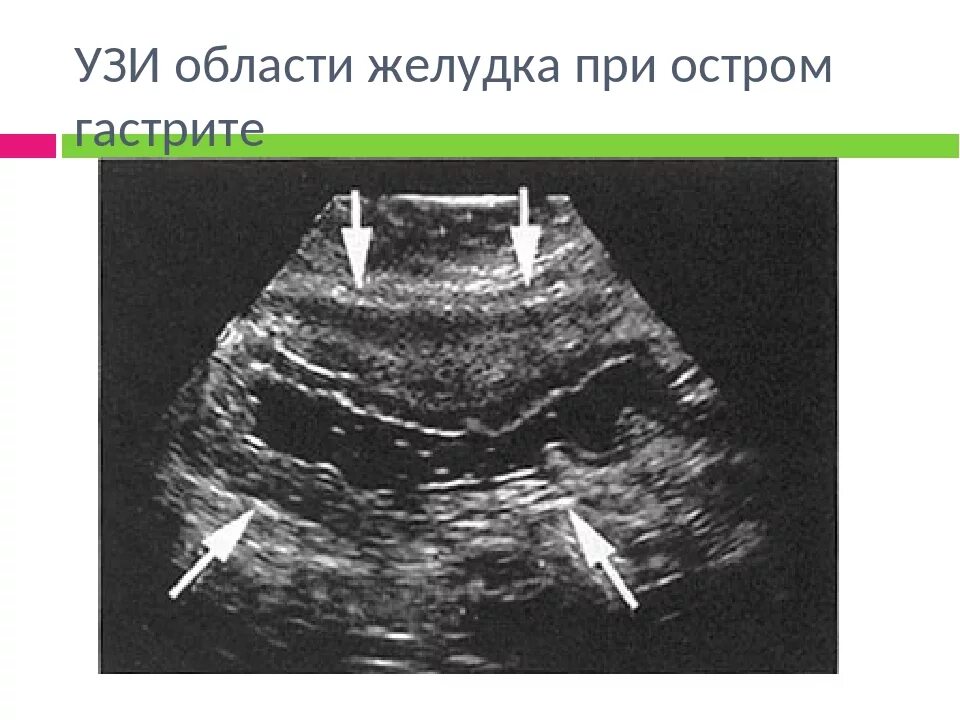 УЗИ желудка собаки гастрит. Хронический гастрит УЗИ.