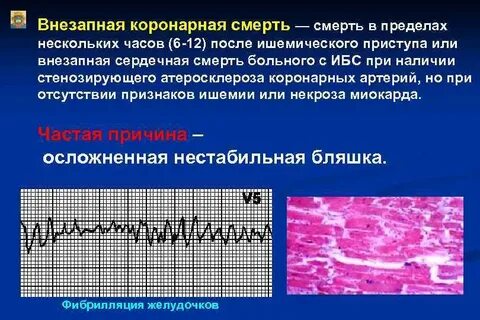 Внезапная коронарная
