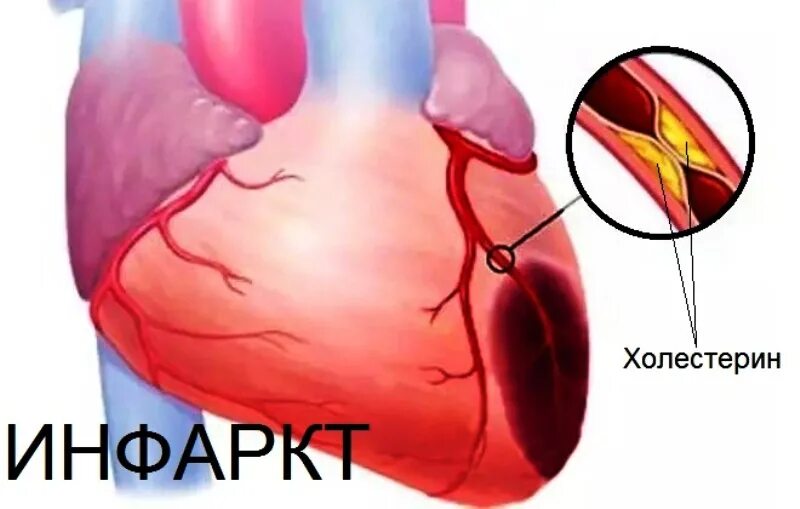 Осложнение на сердце после. Сердце при инфаркте миокарда. Сердце после инфаркта миокарда.