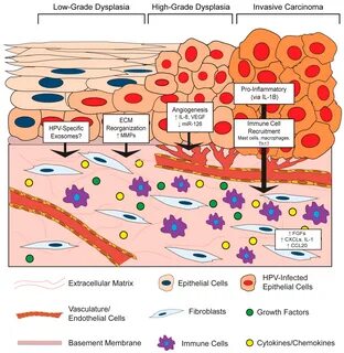 Low grade dysplasia