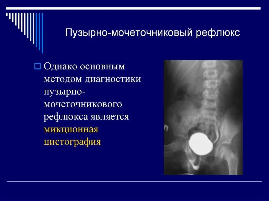 Рефлюкс мочеточника. Пузырно-мочеточниковый рефлюкс микционная цистография. Микционная цистография рефлюкс. Микционная цистоуретрография пузырно-мочеточниковый рефлюкс. Пузырно-мочеточниковый рефлюкс пассивный.