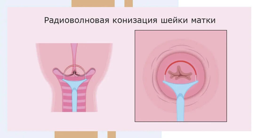 Конизация шейки матки до и после - Onnyx.ru