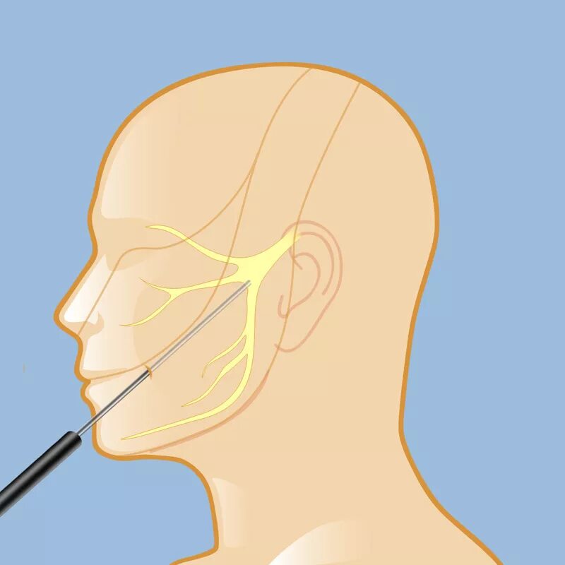 Неврит нижнечелюстного нерва. Блокада при невралгии тройничного нерва. Лечебные блокады при невралгии тройничного нерва. Курковые зоны тройничного нерва. Лицевой нерв челюсти