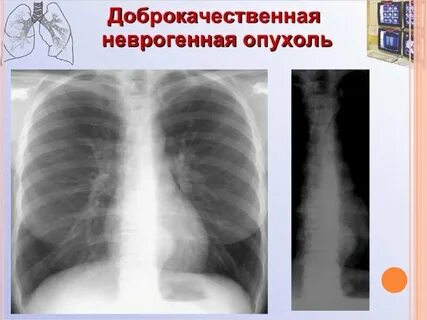 Доброкачественные опухоли средостения