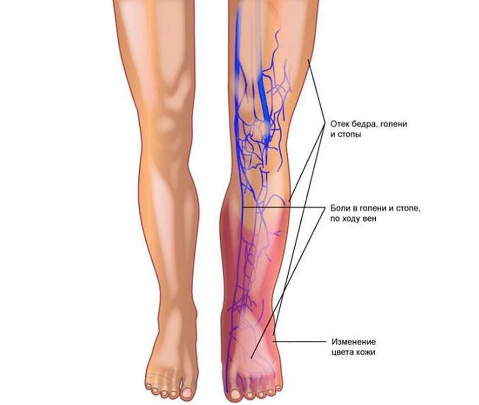 Боль в ногах от бедра до стопы. Тромбофлебит подкожных вен. Варикоз флебит тромбофлебит. Варикозная болезнь вен нижних конечностей симптомы. Тромбоз глубоких вен нижних конечностей клиника.