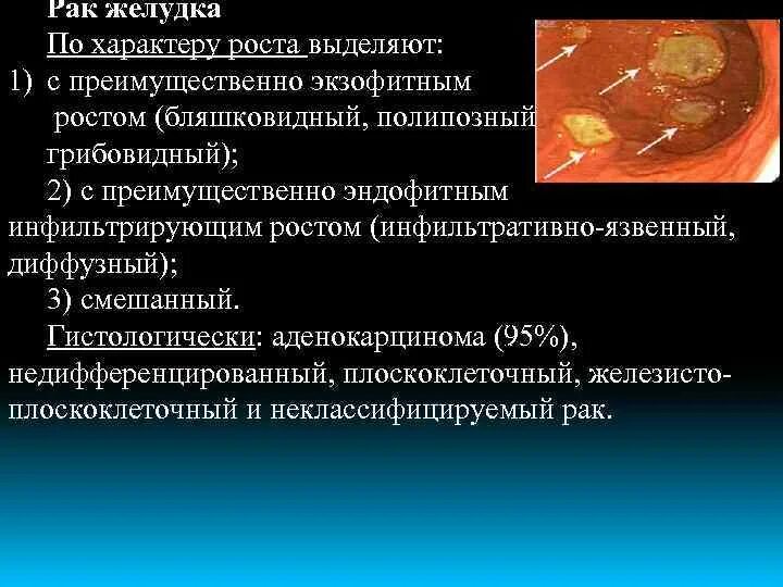 Рак желудка 4 сколько живут. Инфильтративная опухоль желудка. Диффузно-инфильтративная опухоль желудка. Раковая опухоль желудка.