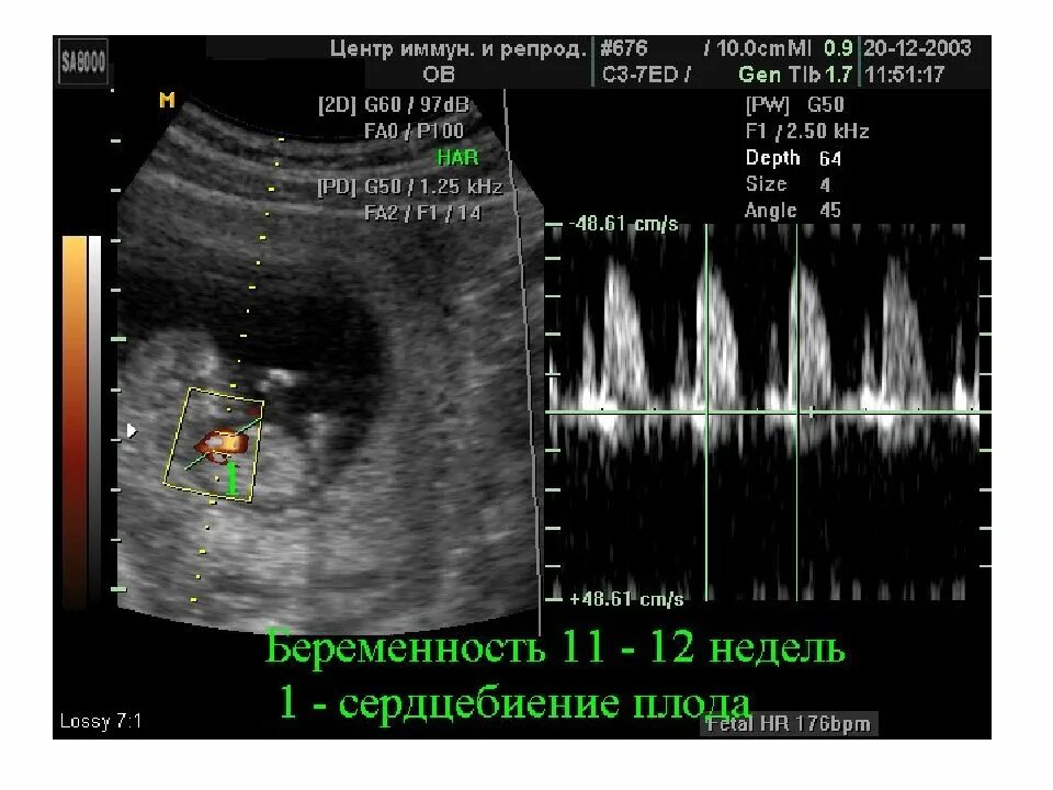 На какой недели бьется сердце плода. Чсс на узи. сердцебиение на узи. сердцебиение ребенка на узи. чсс плода узи.