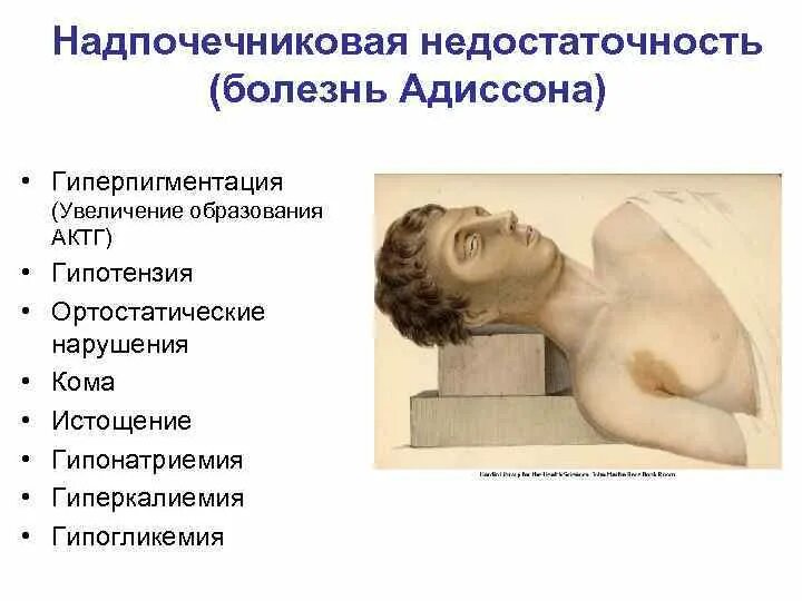 Надпочечниковая недостаточность гиперпигментация. Надпочечниковая недостаточность. Стадии острой надпочечниковой недостаточности. Пациенты с надпочечниковой недостаточностью. Хронической надпочечниковой недостаточности.