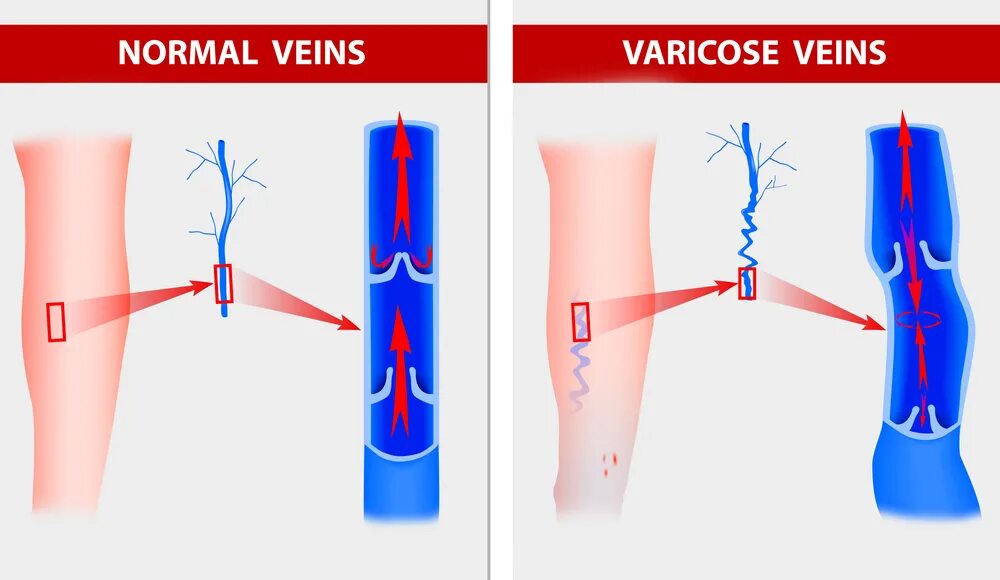 Нормальному кровообращению. Нормальная и варикозная Вена. Клапанный аппарат нормальной и варикозной вены. Варикозное расширение вен (ВРВ) нижних конечностей.